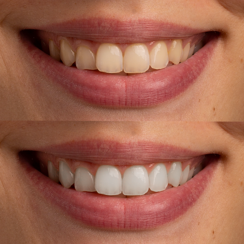 Използвам въглен през вечер от две седмици и петната от кафе изчезнаха напълно. Зъбите ми са гладки на допир и имат естествен блясък, без никаква чувствителност.