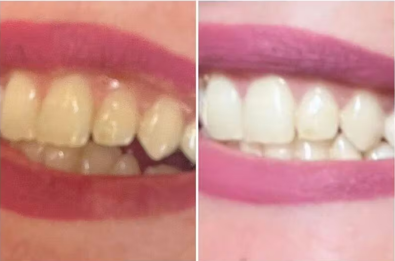 Продуктът е отличен, резултатите са видими веднага, дори опаковката, в която е доставен въгленът, мирише. Благодаря ти, красавице ❤️