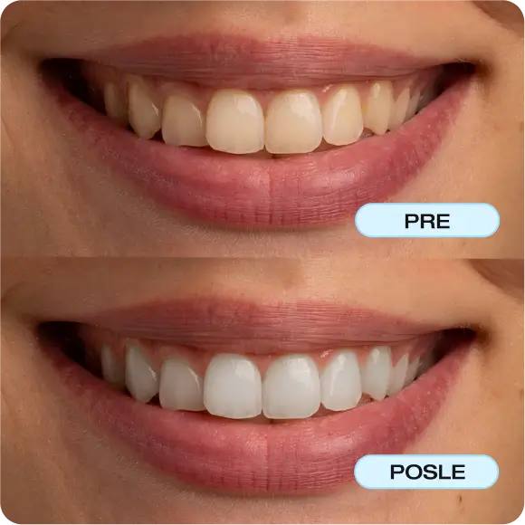 „Бях скептична, когато ги видях, но се оказа, че наистина работят. Зъбите ми станаха с няколко нюанса по-бели само след седмица!“